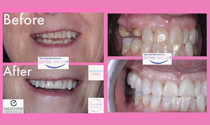 Dental Implants - Before and After